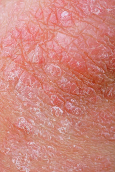 Psoriasis