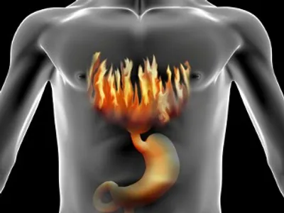 Solutions for Reflux or GERD