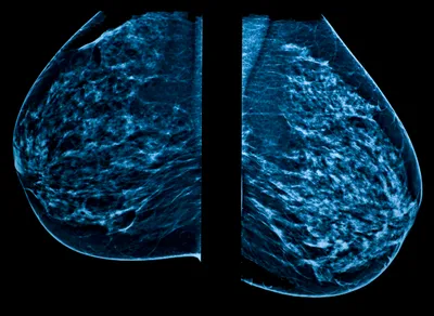 Mammograms Again