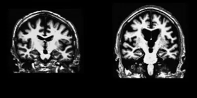 Sleep Loss and Brain Aging