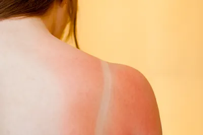 Hold the Sunscreen to prevent Melanoma?